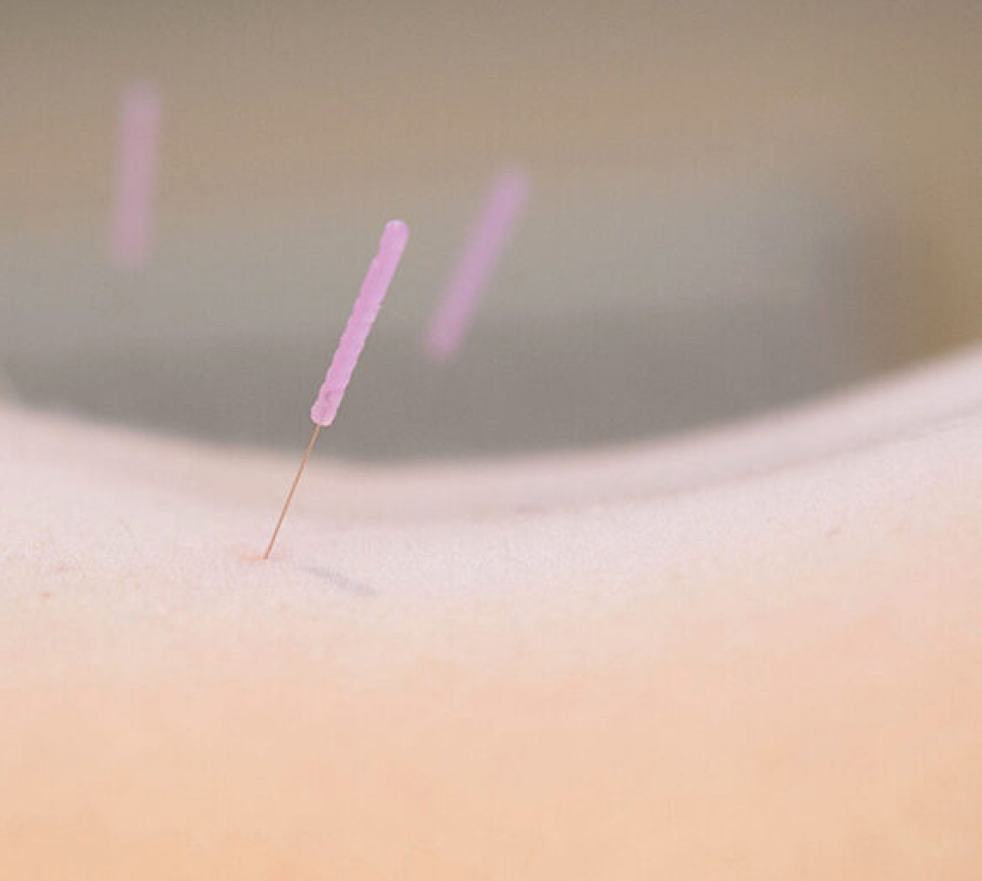 Acupuncture in Richmond